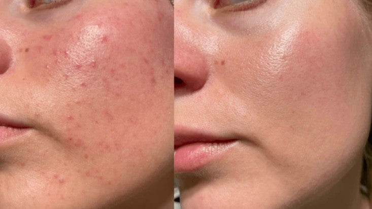 La routine de Julie 22 ans contre l'acné