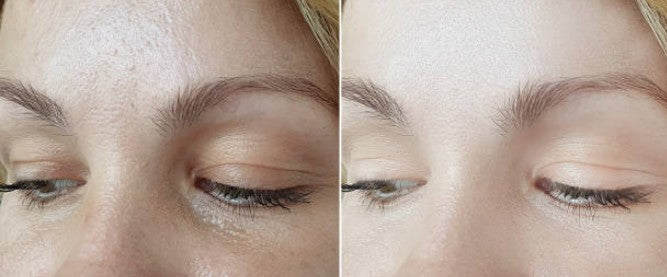 La routine Emilie 37 ans pour limité l'apparence des ridules